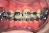 Teeth with braces